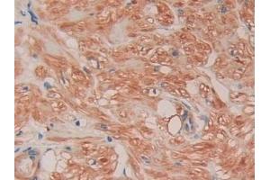 Detection of FLNC in Human Prostate Tissue using Polyclonal Antibody to Filamin C Gamma (FLNC)