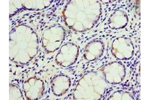 Immunohistochemistry of paraffin-embedded human colon cancer using ABIN7146792 at dilution of 1:100 (CEACAM3 anticorps  (AA 1-135))