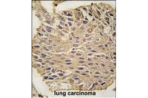 Formalin-fixed and paraffin-embedded human lung carcinoma tissue reacted with ALDOA antibody (C-term) (ABIN389192 and ABIN2839355) , which was peroxidase-conjugated to the secondary antibody, followed by DAB staining. (ALDOA anticorps  (C-Term))