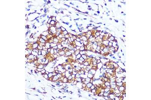 Immunohistochemistry of paraffin-embedded human esophageal cancer using Pannexin 1 Rabbit mAb (ABIN7269168) at dilution of 1:100 (40x lens).