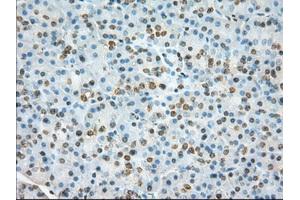 Immunohistochemical staining of paraffin-embedded Adenocarcinoma of colon tissue using anti-TACC3 mouse monoclonal antibody. (TACC3 anticorps)
