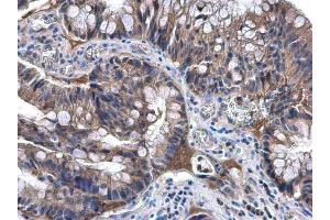 IHC-P Image NAT1 antibody [N1C1] detects NAT1 protein at cytoplasm in human colon carcinoma by immunohistochemical analysis. (NAT1 anticorps)