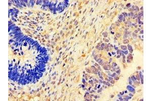 Immunohistochemistry of paraffin-embedded human ovarian cancer using ABIN7152824 at dilution of 1:100 (FGF8 anticorps  (AA 23-143))
