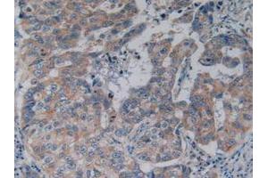IHC-P analysis of Human Breast Cancer Tissue, with DAB staining. (NFkB anticorps  (AA 805-892))