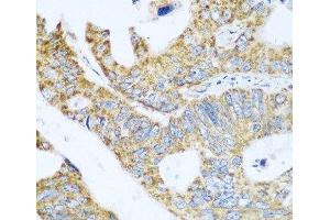 Immunohistochemistry of paraffin-embedded Human colon carcinoma using GLUD1 Polyclonal Antibody at dilution of 1:100 (40x lens). (GLUD1 anticorps)