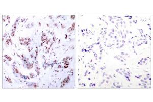 Immunohistochemical analysis of paraffin-embedded human breast carcinoma tissue using MEF2A (Ab-312) antibody (E021039). (MEF2A anticorps)