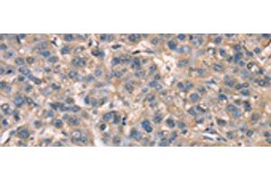Immunohistochemistry of paraffin-embedded Human liver cancer tissue using ZFYVE19 Polyclonal Antibody at dilution of 1:60(x200) (ZFYVE19 anticorps)