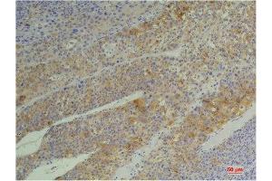 Immunohistochemistry (IHC) analysis of paraffin-embedded Human Heptacarcinoma using Cyclophilin B Mouse Monoclonal Antibody diluted at 1:200.