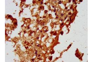 IHC image of ABIN7164700 diluted at 1:100 and staining in paraffin-embedded human melanoma performed on a Leica BondTM system. (HBEGF anticorps  (AA 63-148))