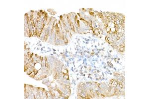 Immunohistochemistry of paraffin-embedded human colon carcinoma using USP18 Rabbit pAb (ABIN7271145) at dilution of 1:25 (40x lens). (USP18 anticorps  (AA 200-300))
