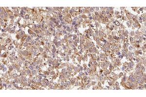 ABIN6278895 at 1/100 staining Human Melanoma tissue by IHC-P. (IL17F anticorps  (Internal Region))