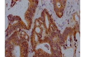 IHC image of ABIN7127869 diluted at 1:100 and staining in paraffin-embedded human colon cancer performed on a Leica BondTM system.