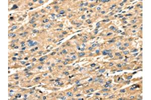 The image on the left is immunohistochemistry of paraffin-embedded Human liver cancer tissue using ABIN7131239(STX18 Antibody) at dilution 1/25, on the right is treated with fusion protein. (Syntaxin 18 anticorps)