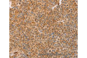 Immunohistochemistry of Human cervical cancer using BRS3 Polyclonal Antibody at dilution of 1:30