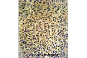 FUT6 Antibody IHC analysis in formalin fixed and paraffin embedded bladder carcinoma followed by peroxidase conjugation of the secondary antibody and DAB staining. (FUT6 anticorps  (AA 102-130))