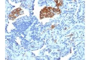IHC testing of FFPE human lung carcinoma with DC-SIGN antibody (clone C209/1781). (DC-SIGN/CD209 anticorps)
