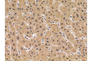 ABIN6256932 and ABIN6275042 at 1/100 staining human liver cancer by IHC-P.