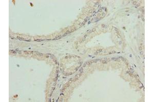 Immunohistochemistry of paraffin-embedded human prostate cancer using ABIN7164554 at dilution of 1:100 (SLC31A2 anticorps  (AA 44-93))