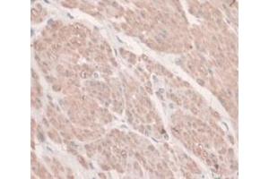 DAB staining on IHC-P; Samples: Human Prostate Gland Cancer Tissue. (HFE2 anticorps  (AA 234-416))