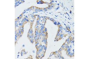 Immunohistochemistry of paraffin-embedded human gastric cancer using USO1 antibody. (USO1 anticorps)