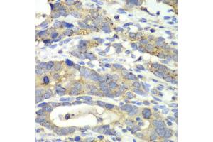 Immunohistochemistry of paraffin-embedded human gastric cancer using CHMP2B antibody (ABIN6292876) at dilution of 1:100 (40x lens).