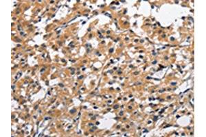 The image on the left is immunohistochemistry of paraffin-embedded Human thyroid cancer tissue using ABIN7128963(CLEC2D Antibody) at dilution 1/70, on the right is treated with fusion protein.