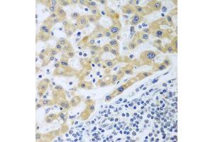 Immunohistochemistry of paraffin-embedded human liver cancer using SHBG antibody (ABIN6129327, ABIN6147736, ABIN6147737 and ABIN6223329) at dilution of 1:100 (40x lens).