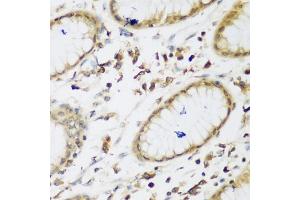 Immunohistochemistry of paraffin-embedded human gastric using UBE3A antibody (ABIN5975332) at dilution of 1/200 (40x lens). (ube3a anticorps)