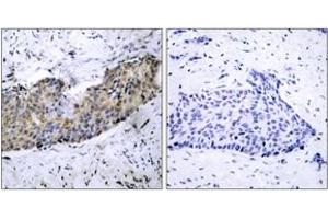 Immunohistochemistry analysis of paraffin-embedded human breast carcinoma tissue, using VEGFR2 (Ab-1214) Antibody. (VEGFR2/CD309 anticorps  (AA 1180-1229))