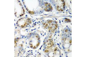 Immunohistochemistry of paraffin-embedded human colon carcinoma using CRYAA antibody at dilution of 1:200 (40x lens). (CRYAA anticorps)