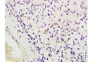 Formalin-fixed and human glioma tissue labeled with Anti-MSR1/CD204 Polyclonal Antibody, Unconjugated  at 1:200 followed by conjugation to the secondary antibody and DAB staining