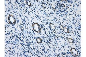 Immunohistochemical staining of paraffin-embedded Adenocarcinoma of breast tissue using anti-ACO2 mouse monoclonal antibody. (ACO2 anticorps)