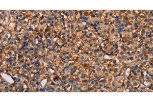 Immunohistochemistry of paraffin-embedded Human prostate cancer tissue using PLXNA1 Polyclonal Antibody at dilution 1:30 (Plexin A1 anticorps)