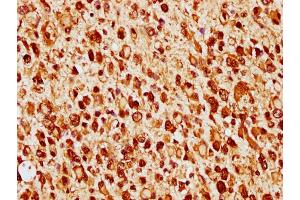 IHC image of nforHU diluted at 1:14 and staining in paraffin-embedded human glioma cancer performed on a Leica BondTM system.