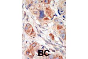 Formalin-fixed and paraffin-embedded human cancer tissue reacted with PIK3CD polyclonal antibody  , which was peroxidase-conjugated to the secondary antibody, followed by DAB staining. (PIK3CD anticorps  (C-Term))