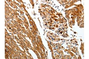 The image on the left is immunohistochemistry of paraffin-embedded Human cervical cancer tissue using ABIN7192428(SLC22A3 Antibody) at dilution 1/25, on the right is treated with synthetic peptide. (SLC22A3 anticorps)