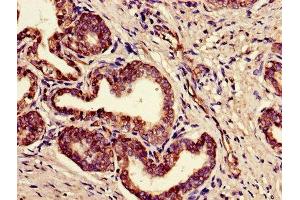 Immunohistochemistry of paraffin-embedded human prostate cancer using ABIN7165494 at dilution of 1:100 (FAM3B anticorps  (AA 31-235))
