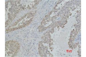 Immunohistochemistry (IHC) analysis of paraffin-embedded Human Lung Carcicnoma using Mouse Monoclonal Antibody diluted at 1:500.