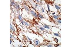 IHC analysis of FFPE human breast carcinoma tissue stained with the ISG15 antibody (ISG15 anticorps  (AA 31-61))