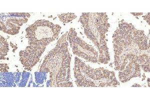 Immunohistochemistry of paraffin-embedded Human lung cancer tissue using CA9 Monoclonal Antibody at dilution of 1:200.