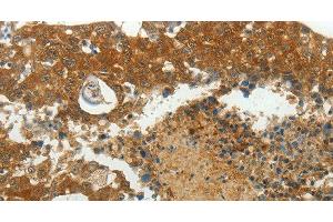 Immunohistochemistry of paraffin-embedded Human breast cancer using MCM4 Polyclonal Antibody at dilution of 1:40 (MCM4 anticorps)