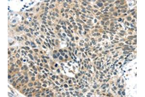 The image on the left is immunohistochemistry of paraffin-embedded Human esophagus cancer tissue using ABIN7192941(TSPY1 Antibody) at dilution 1/40, on the right is treated with synthetic peptide. (TSPY1 anticorps)