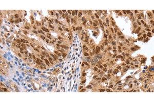 Immunohistochemistry of paraffin-embedded Human ovarian cancer using PARP1 Polyclonal Antibody at dilution of 1:40