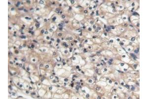 DAB staining on IHC-P; Samples: Human Renal cancer Tissue (BMP7 anticorps  (AA 30-431))