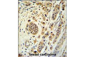 FBXL15 Antibody immunohistochemistry analysis in formalin fixed and paraffin embedded human breast carcinoma followed by peroxidase conjugation of the secondary antibody and DAB staining. (FBXL15 anticorps  (C-Term))