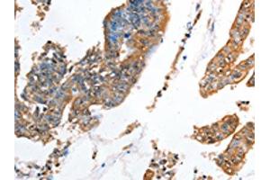 The image on the left is immunohistochemistry of paraffin-embedded Human colon cancer tissue using ABIN7128332(AKR1D1 Antibody) at dilution 1/35, on the right is treated with fusion protein. (AKR1D1 anticorps)