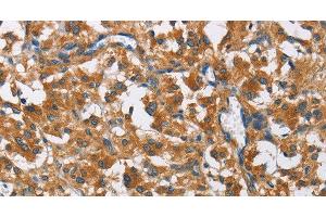Immunohistochemistry of paraffin-embedded Human thyroid cancer using COPB1 Polyclonal Antibody at dilution of 1:50 (COPB1 anticorps)