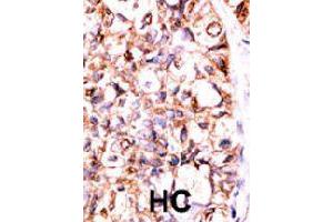 Formalin-fixed and paraffin-embedded human hepatocellular carcinoma tissue reacted with PPP5C polyclonal antibody  , which was peroxidase-conjugated to the secondary antibody, followed by AEC staining. (PP5 anticorps  (C-Term))