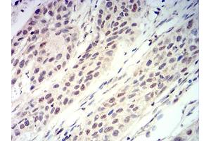 Immunohistochemical analysis of paraffin-embedded esophageal cancer tissues using RUNX3 mouse mAb with DAB staining. (RUNX3 anticorps  (AA 294-429))