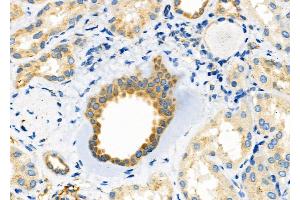 ABIN6265126 and ABIN6272496 at 1/100 staining Human kidney cancer and adjacent normal tissues by IHC-P. (SLC30A2 anticorps  (Internal Region))